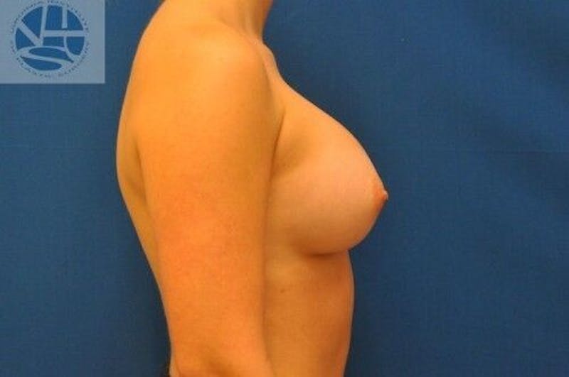 Breast Augmentation Before & After Gallery - Patient 55345388 - Image 8