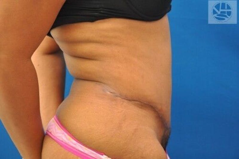 Tummy Tuck Before & After Gallery - Patient 55345392 - Image 6