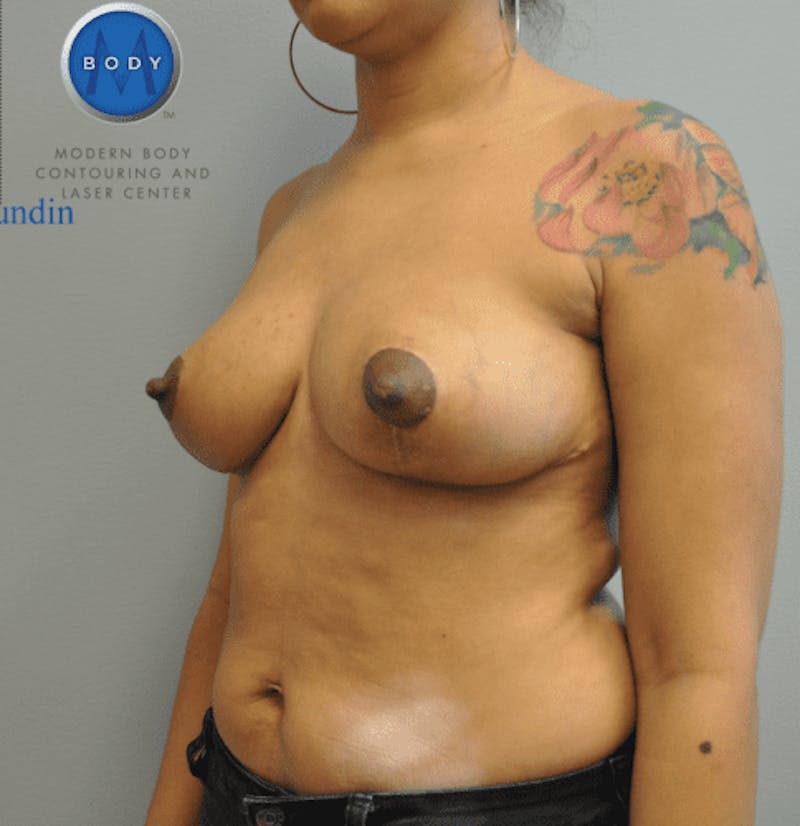 Breast Lift Before & After Gallery - Patient 55345390 - Image 8