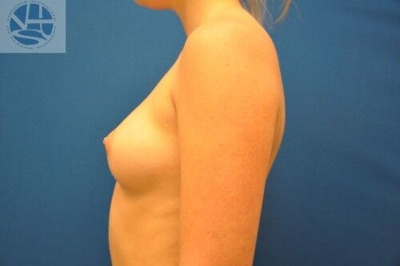 Breast Augmentation Before & After Gallery - Patient 55345388 - Image 9