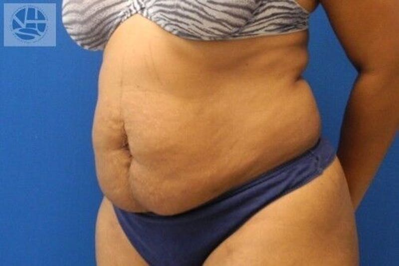 Tummy Tuck Before & After Gallery - Patient 55345392 - Image 7