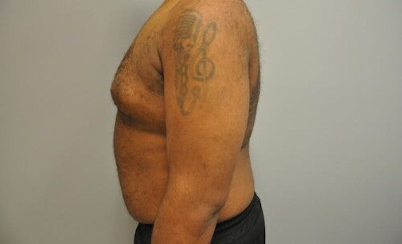 Liposuction Gallery - Patient 55345389 - Image 9
