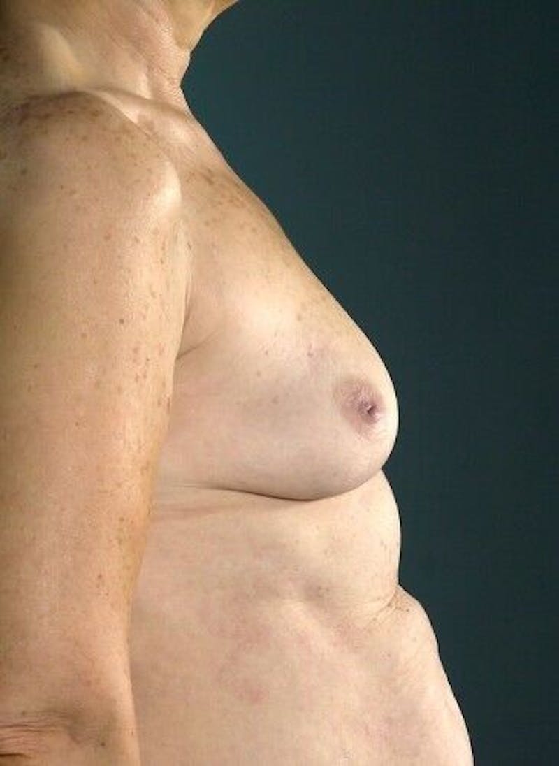 Breast Augmentation with Lift Before & After Gallery - Patient 55345391 - Image 5