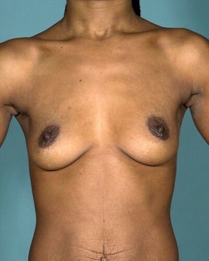 Breast Augmentation Before & After Gallery - Patient 55345394 - Image 1