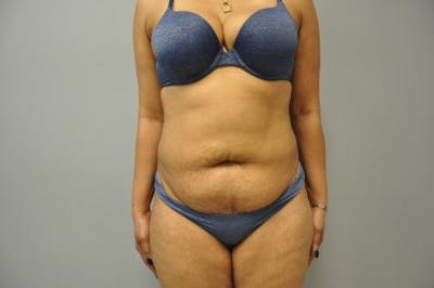 Liposuction Before & After Gallery - Patient 211876593 - Image 1