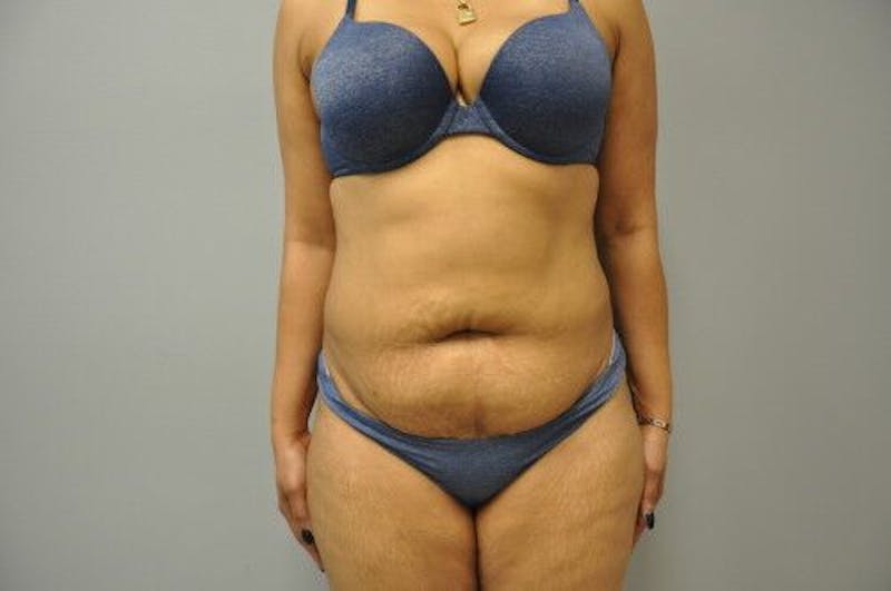 Liposuction Before & After Gallery - Patient 211876593 - Image 1