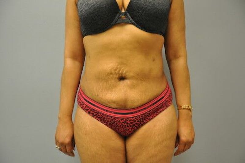 Liposuction Before & After Gallery - Patient 55345399 - Image 2