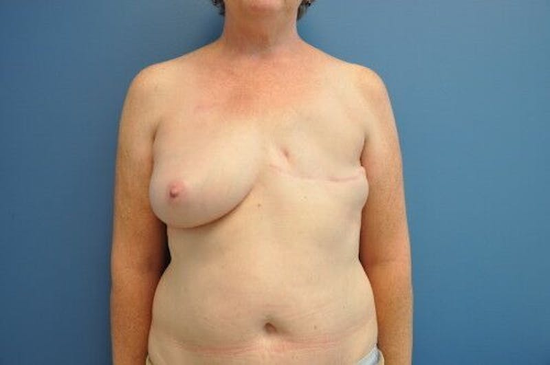 Breast Reconstruction Before & After Gallery - Patient 55345396 - Image 1