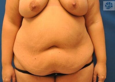Extended Tummy Tuck Before & After Gallery - Patient 294278 - Image 1