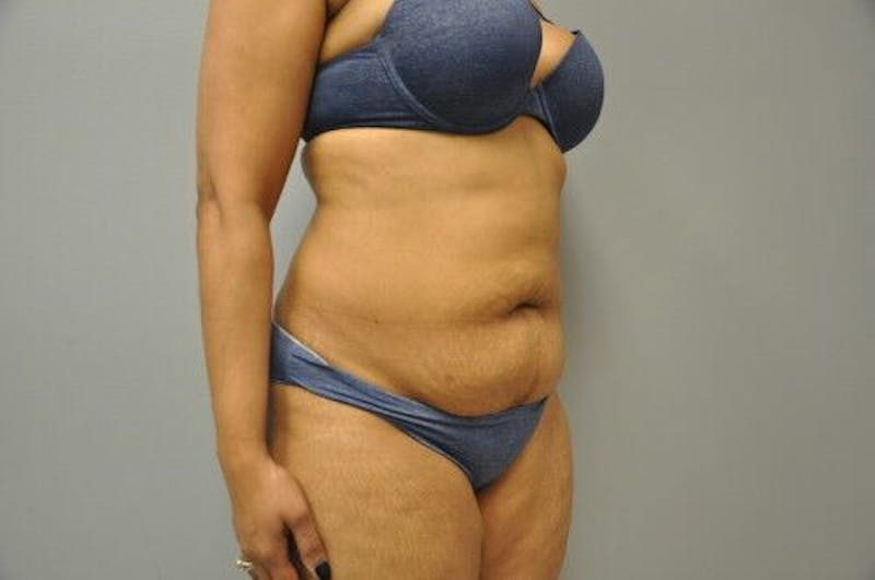 Liposuction Before & After Gallery - Patient 211876593 - Image 3