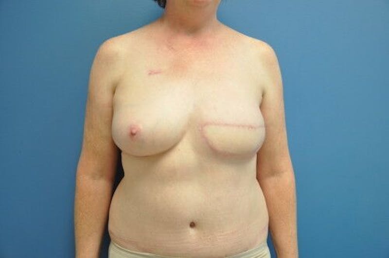 Breast Reconstruction Before & After Gallery - Patient 55345396 - Image 2