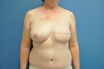 Breast Reconstruction Gallery - Patient 55345396 - Image 2