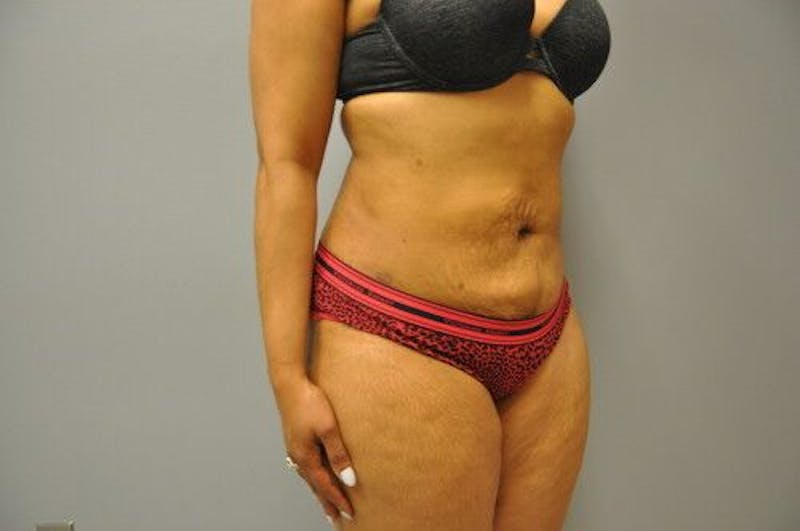 Liposuction Before & After Gallery - Patient 211876593 - Image 4
