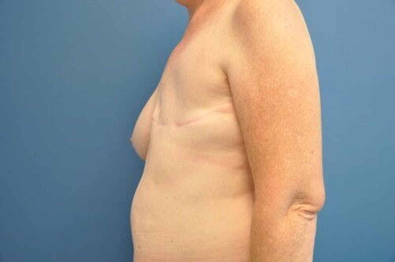 Breast Reconstruction Before & After Gallery - Patient 55345396 - Image 3