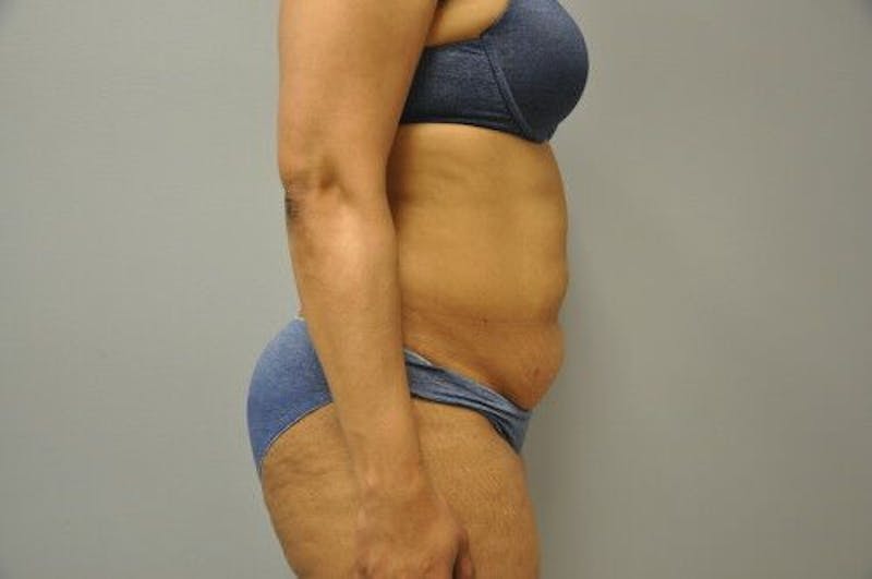 Liposuction Before & After Gallery - Patient 211876593 - Image 5