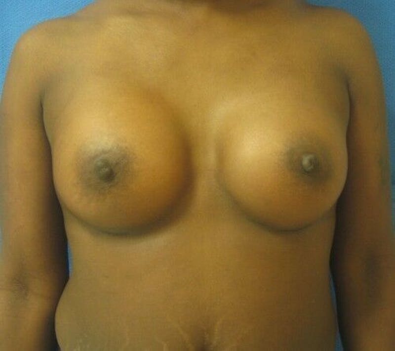 Breast Augmentation Before & After Gallery - Patient 55345398 - Image 2