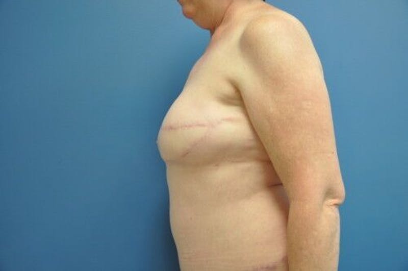 Breast Reconstruction Before & After Gallery - Patient 55345396 - Image 4