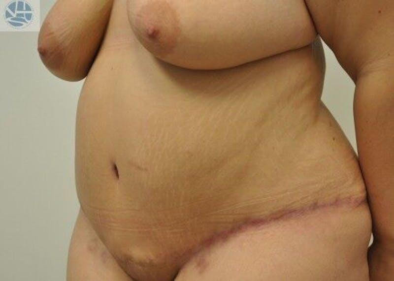 Tummy Tuck Before & After Gallery - Patient 55345401 - Image 4