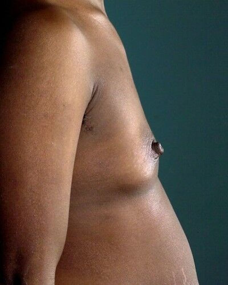 Breast Augmentation Before & After Gallery - Patient 55345398 - Image 3