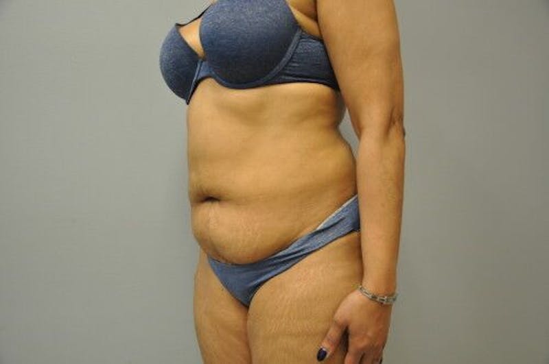 Liposuction Before & After Gallery - Patient 211876593 - Image 7