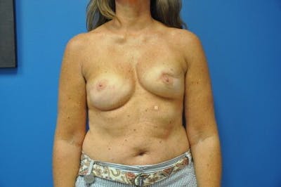 Breast Reconstruction Gallery - Patient 55345402 - Image 1