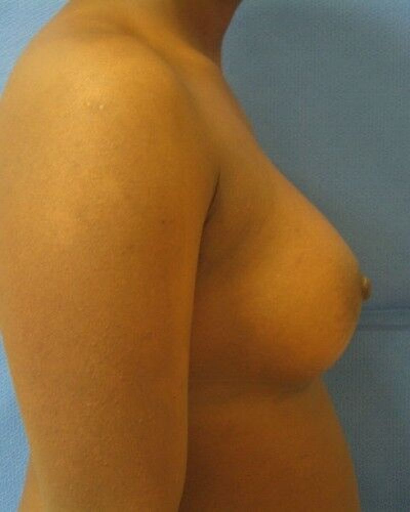 Breast Augmentation Before & After Gallery - Patient 55345398 - Image 4