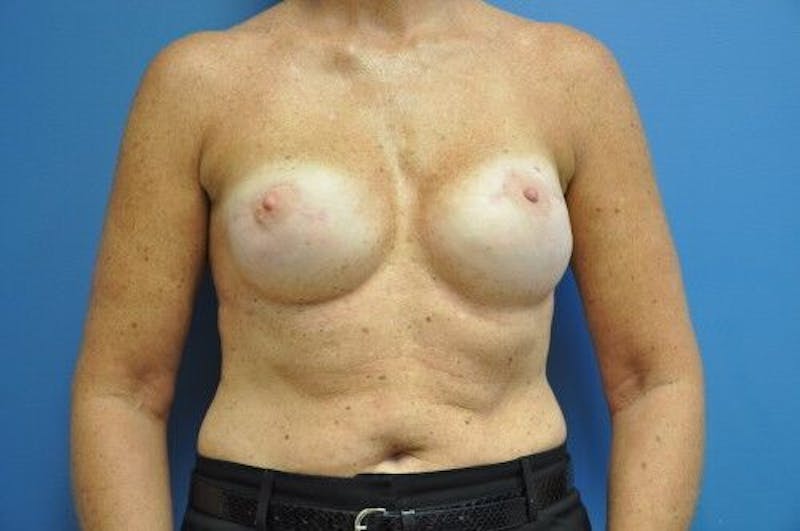 Breast Reconstruction Before & After Gallery - Patient 55345402 - Image 2