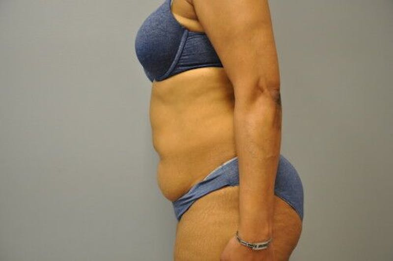 Liposuction Before & After Gallery - Patient 211876593 - Image 9