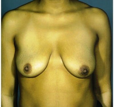 Breast Augmentation with Lift Gallery - Patient 55345400 - Image 1