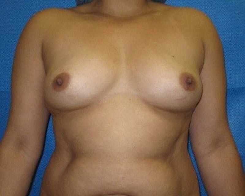 Breast Augmentation Before & After Gallery - Patient 55345404 - Image 1