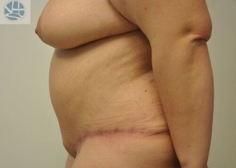 Plus Size Tummy Tuck Before & After Gallery - Patient 294278 - Image 8