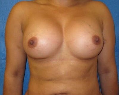Breast Augmentation Before & After Gallery - Patient 55345404 - Image 2