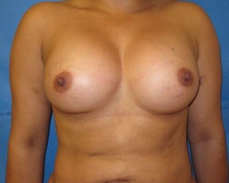 Breast Augmentation Before & After Gallery - Patient 55345404 - Image 2