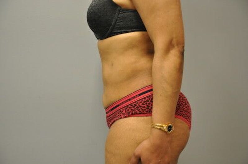 Liposuction Before & After Gallery - Patient 211876593 - Image 10
