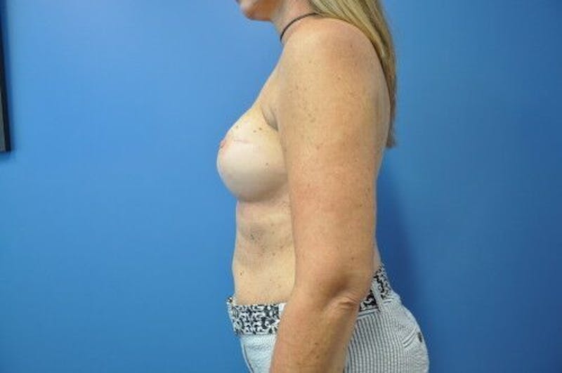 Breast Reconstruction Before & After Gallery - Patient 55345402 - Image 4