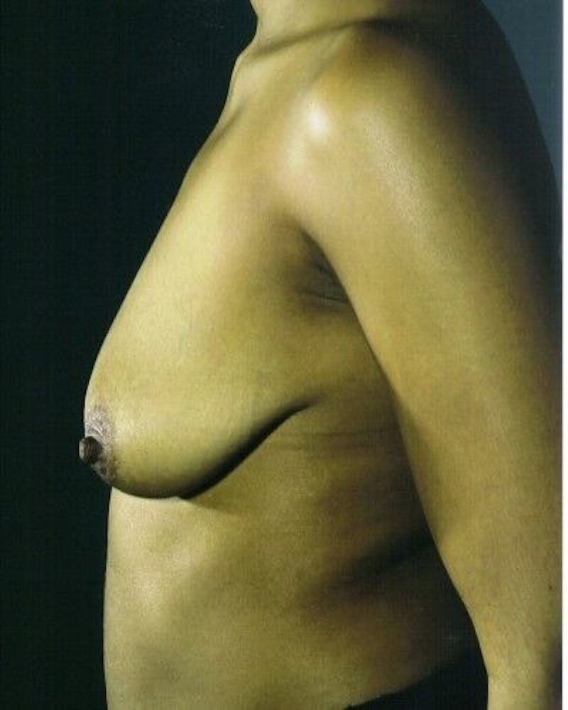Breast Augmentation with Lift Before & After Gallery - Patient 55345400 - Image 3