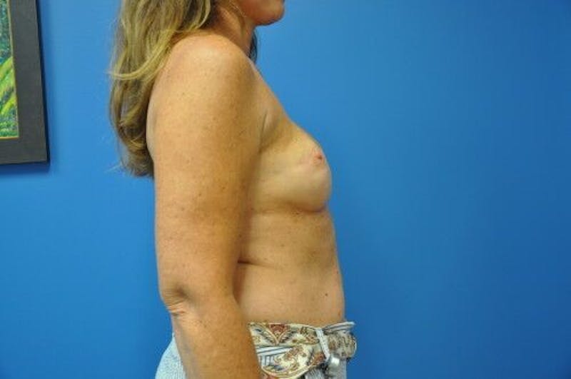 Breast Reconstruction Before & After Gallery - Patient 55345402 - Image 5