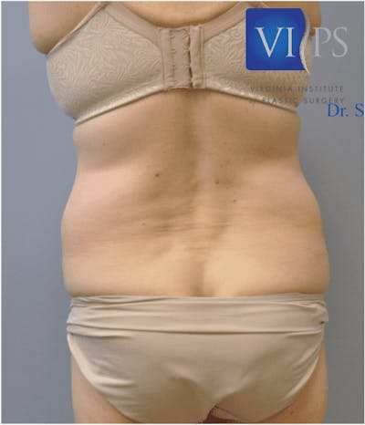 Renuvion J-Plasma Before & After Gallery - Patient 211876544 - Image 1