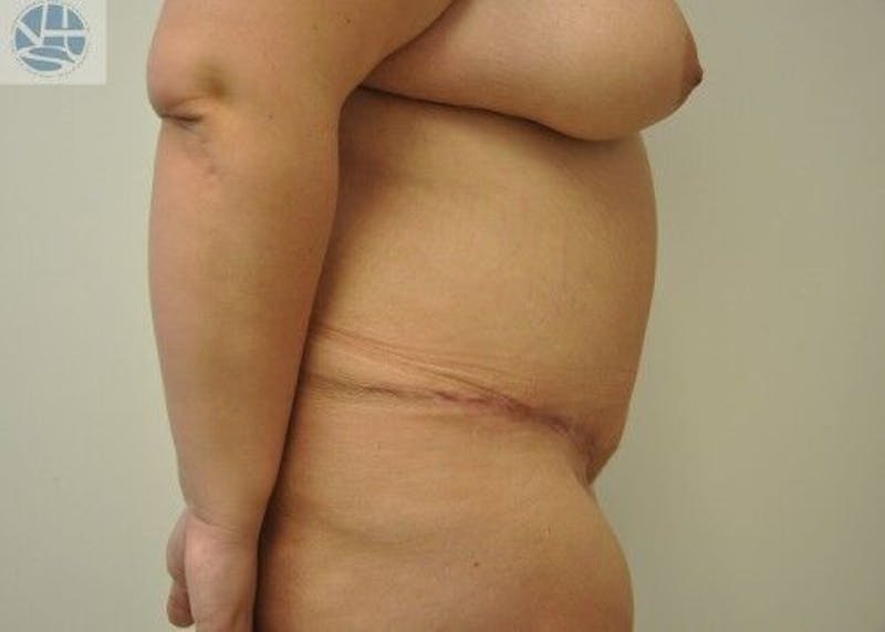 Tummy Tuck Before & After Gallery - Patient 55345401 - Image 10
