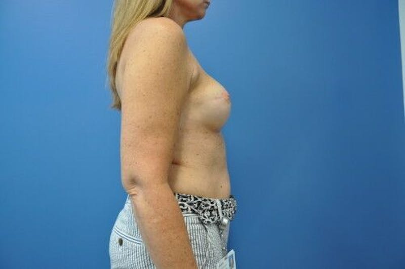 Breast Reconstruction Before & After Gallery - Patient 55345402 - Image 6