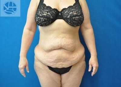 Tummy Tuck Before & After Gallery - Patient 55345413 - Image 1