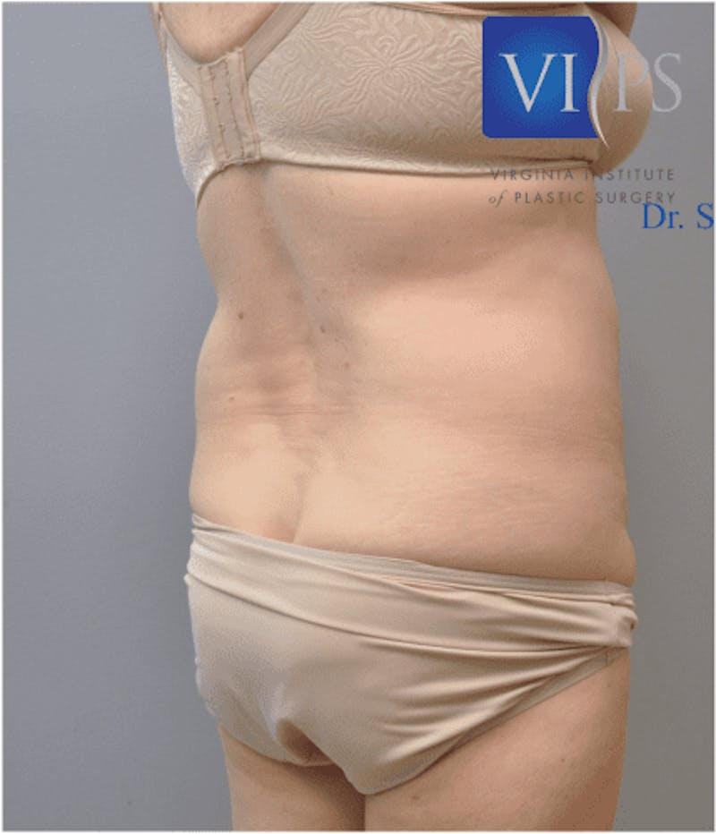 Liposuction Before & After Gallery - Patient 55345411 - Image 3