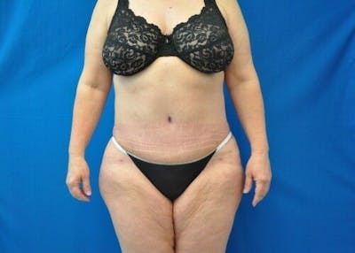 Tummy Tuck Before & After Gallery - Patient 55345413 - Image 2