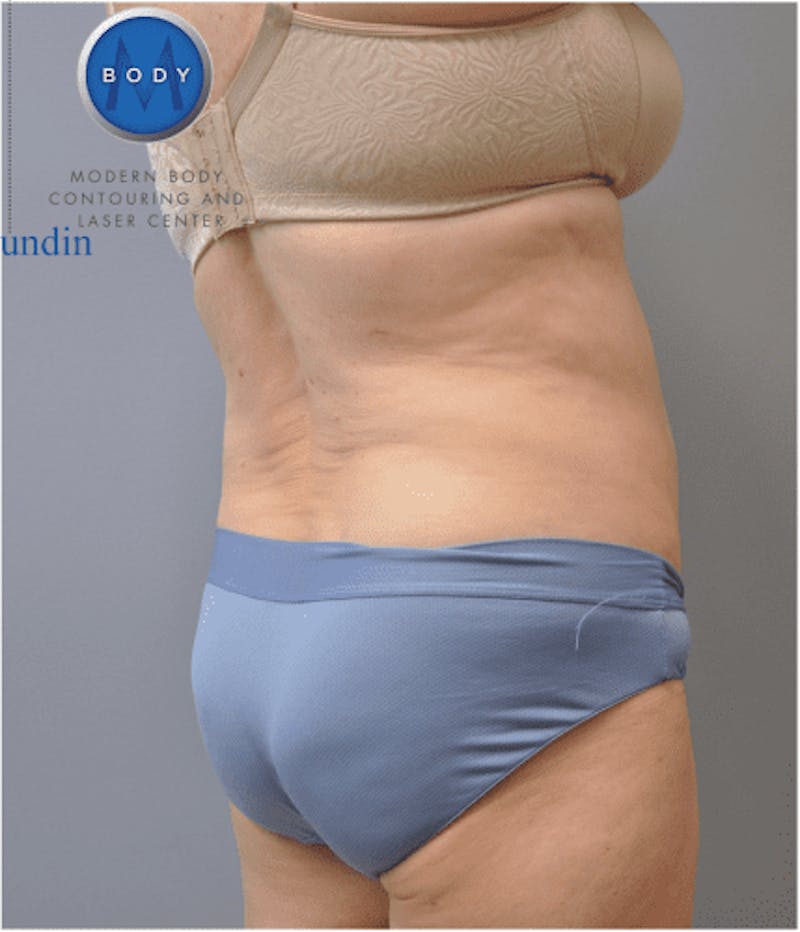 Renuvion J-Plasma Before & After Gallery - Patient 211876544 - Image 4