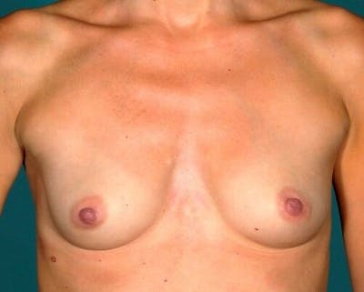Breast Augmentation Before & After Gallery - Patient 55345414 - Image 1