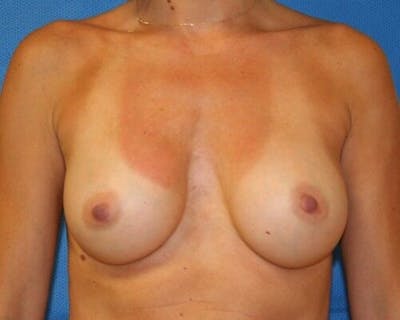 Breast Augmentation Before & After Gallery - Patient 55345414 - Image 2