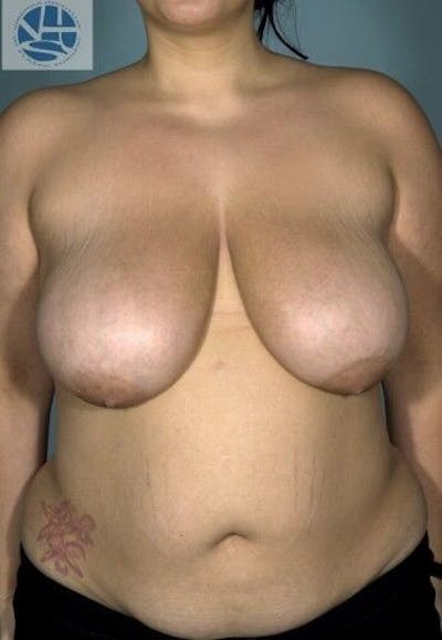 Breast Reduction Gallery - Patient 55345417 - Image 1
