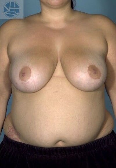 Breast Reduction Gallery - Patient 55345417 - Image 2