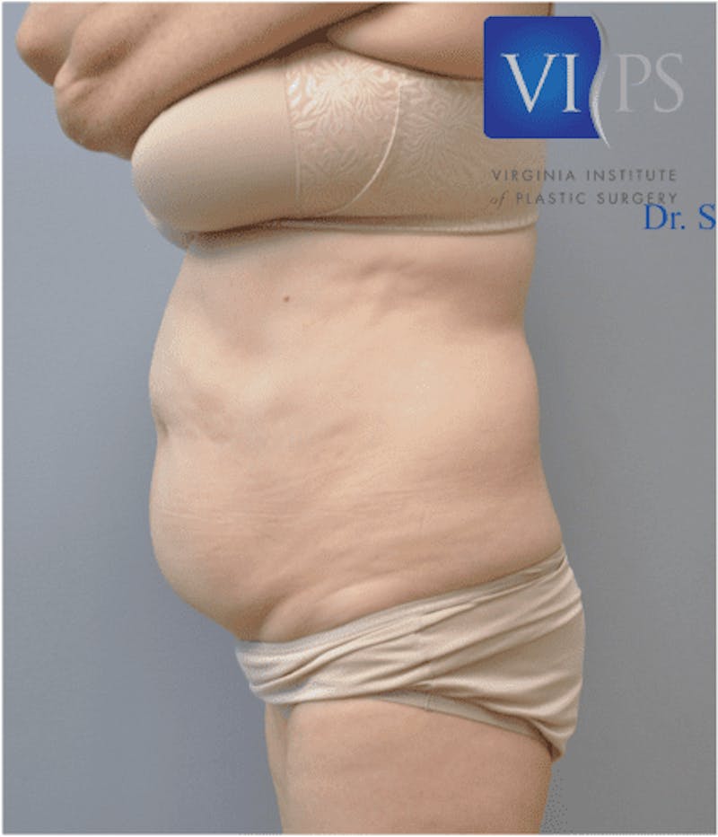 Liposuction Before & After Gallery - Patient 211876599 - Image 7