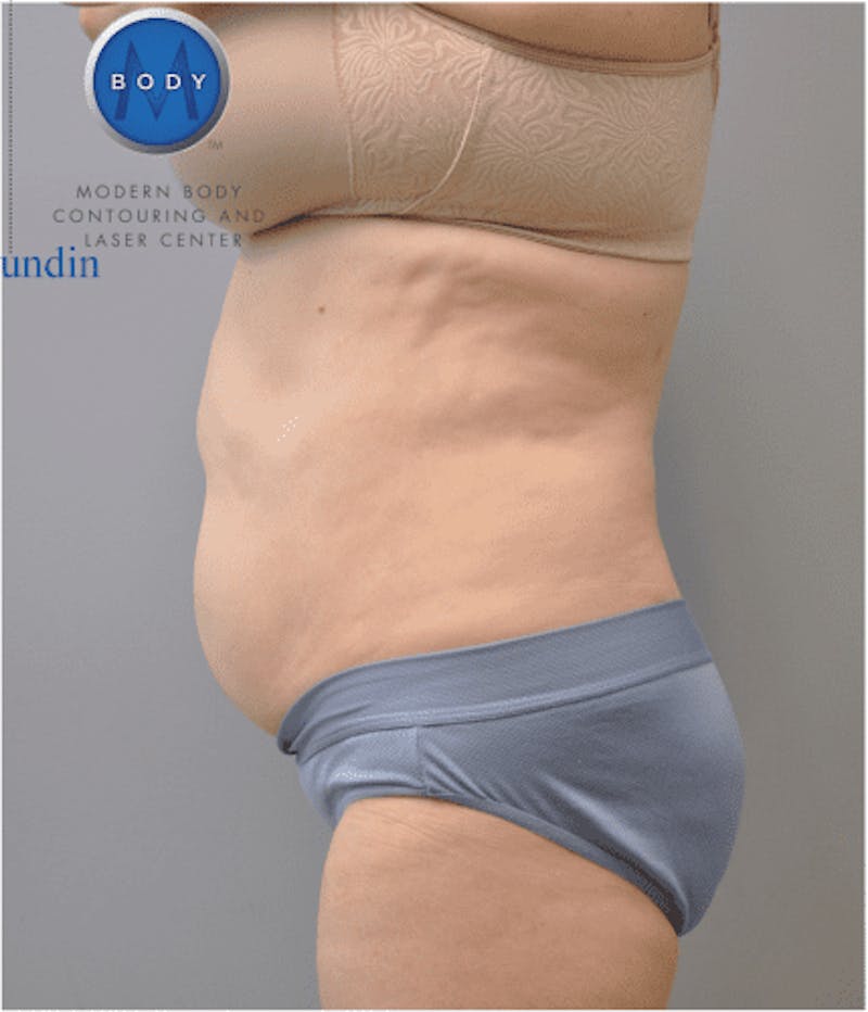 Liposuction Before & After Gallery - Patient 211876599 - Image 8